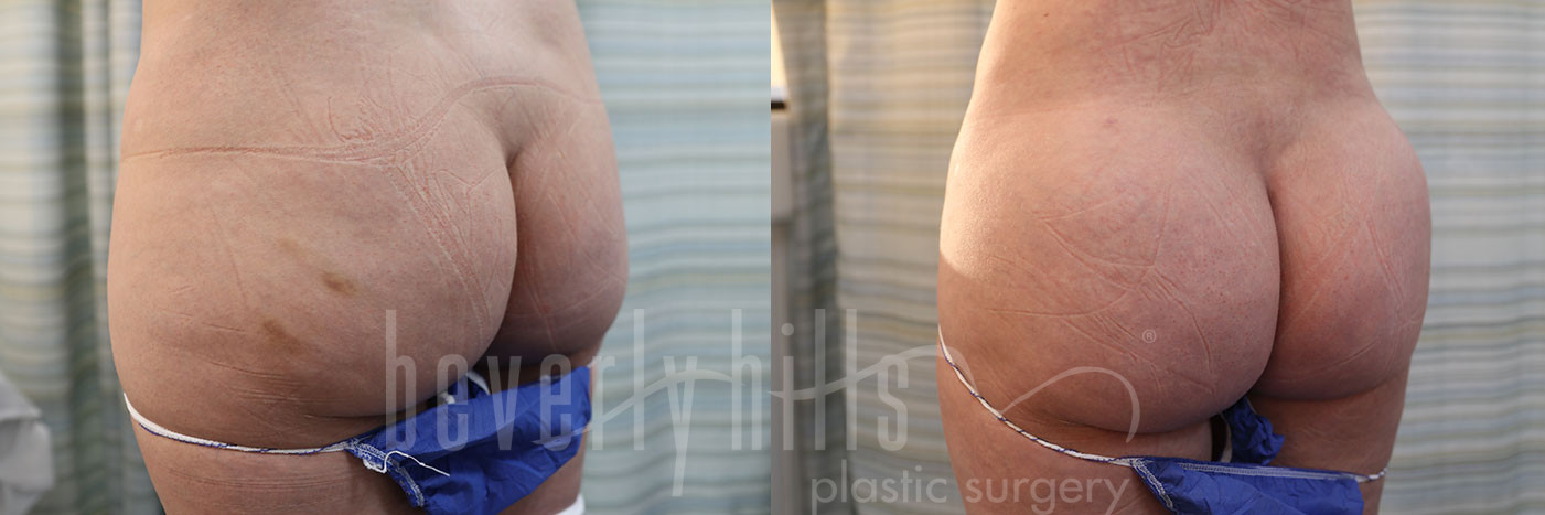 Brazilian Butt Lift Patient 26 Before & After
