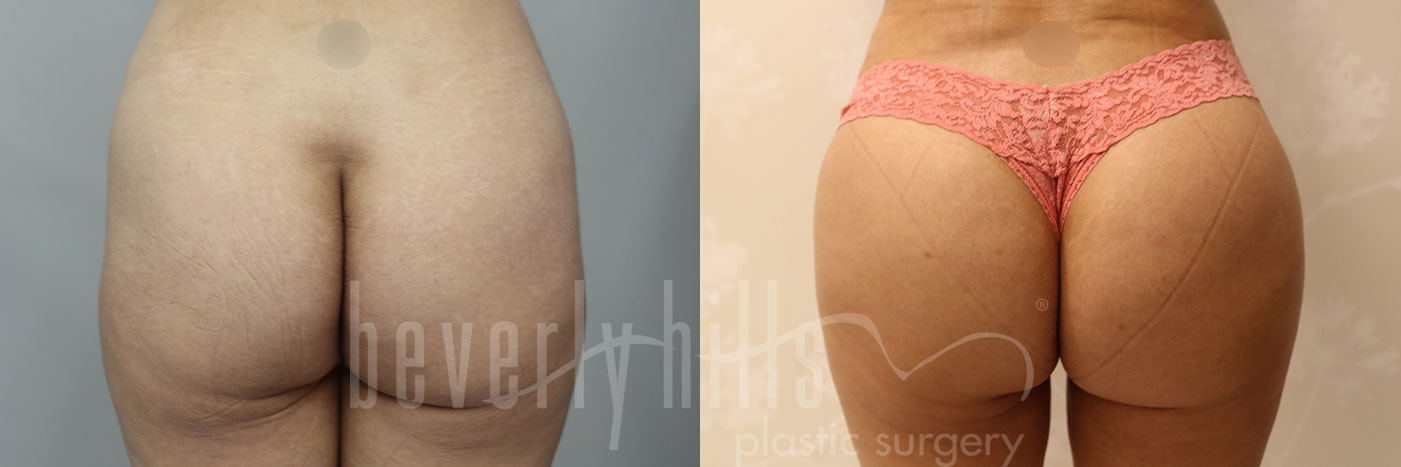 Brazilian Buttock Lift Before & After Photos Patient 278