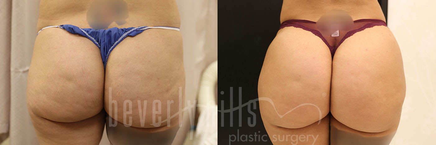Brazilian Butt Lift Patient 25 Before & After