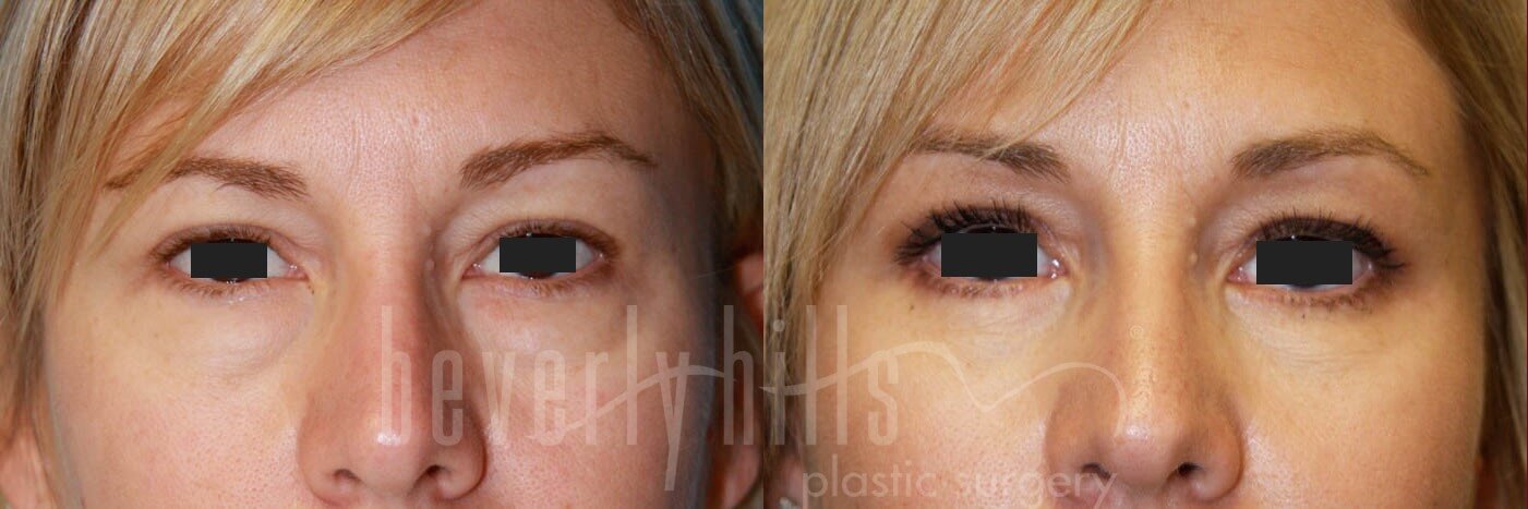 Blepharoplasty Patient 01 Before & After