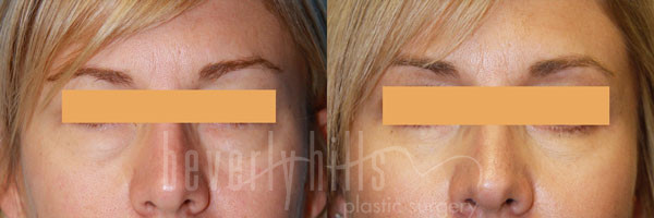 BLEPHAROPLASTY PATIENT 05 Before & After