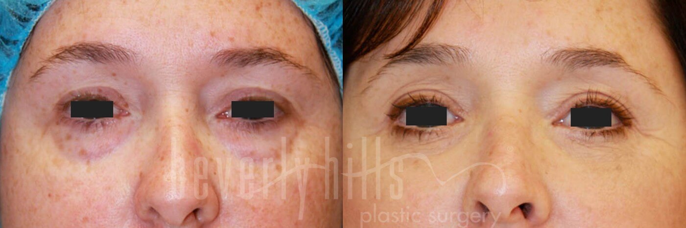Blepharoplasty Patient 02 Before & After