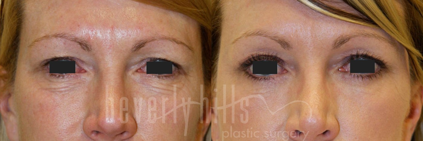 Blepharoplasty Patient 03 Before & After