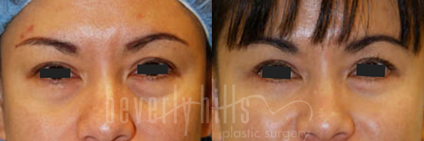 Blepharoplasty Patient 04 Before & After