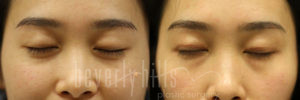Blepharoplasty Patients 06 Before & After - Thumbnail