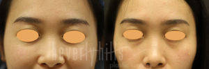Blepharoplasty Patients 06 Before & After - Thumbnail