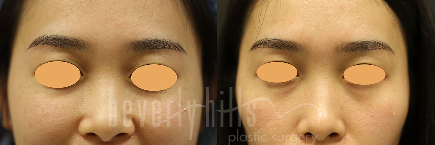 Blepharoplasty Patients 06 Before & After