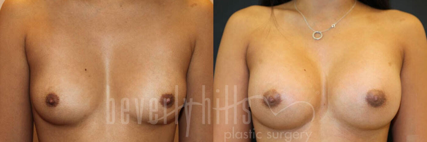 Breast Augmentation 01 Before & After