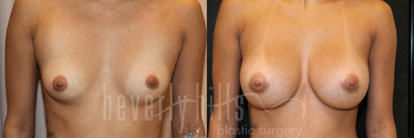 Breast Augmentation 03 Before & After
