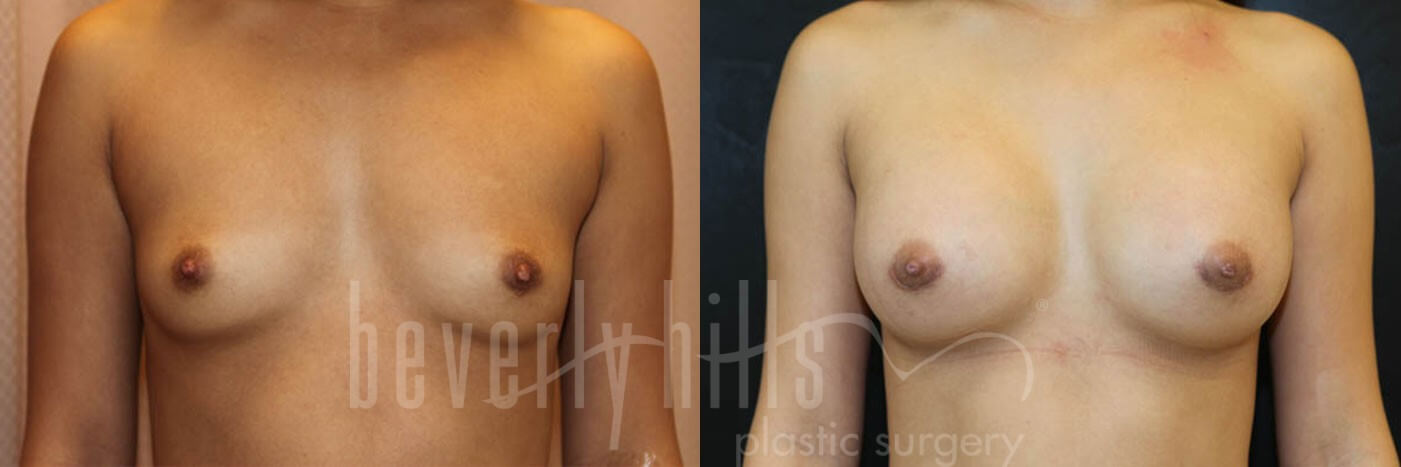Breast Augmentation 04 Before & After