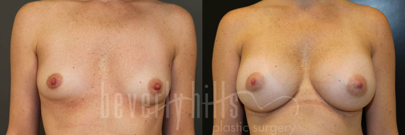Breast Augmentation 05 Before & After
