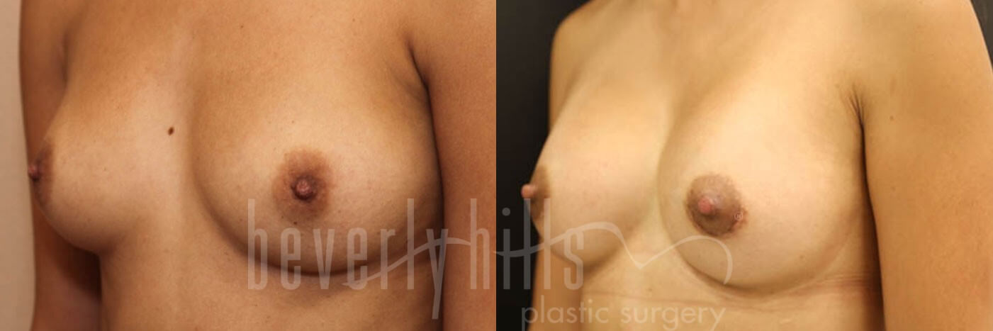 Breast Augmentation 06 Before & After