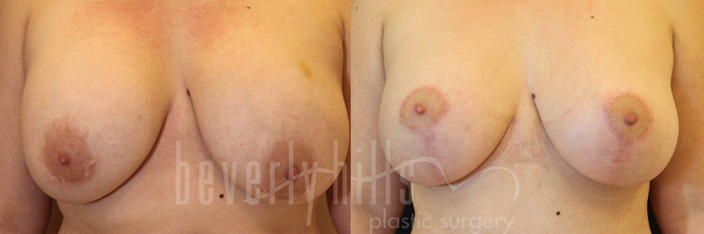 Breast Augmentation 08 Before & After