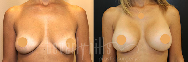 Breast Augmentation Patient 81 Before & After