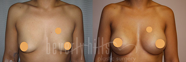 Breast Augmentation Patient 82 Before & After
