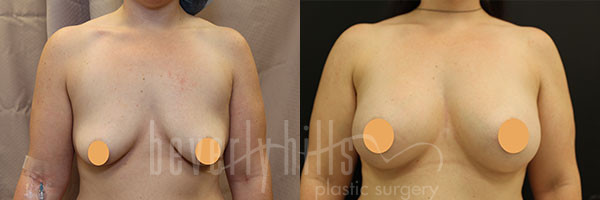 Breast Augmentation Patient 83 Before & After