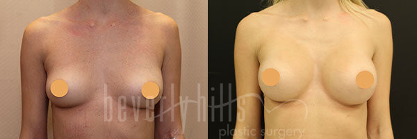 Breast Augmentation Patient 84 Before & After