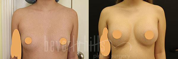Breast Augmentation Patient 85 Before & After