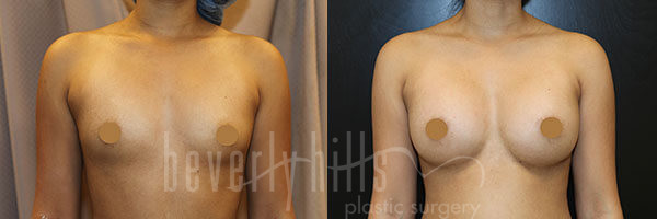 Breast Augmentation Patient 86 Before & After