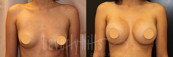 Breast Augmentation Patient 89 Before & After