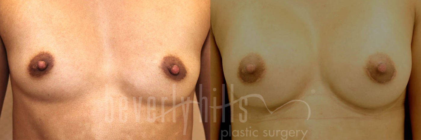 Breast Augmentation 09 Before & After