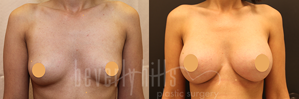 Breast Augmentation Patient 90 Before & After