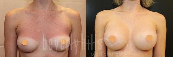 Breast Augmentation Patient 92 Before & After