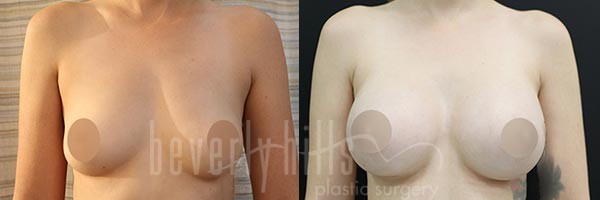 Breast Augmentation Patient 93 Before & After
