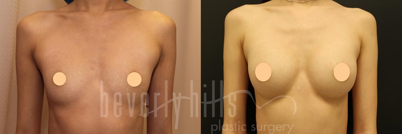 Breast Augmentation Patient 99 Before & After