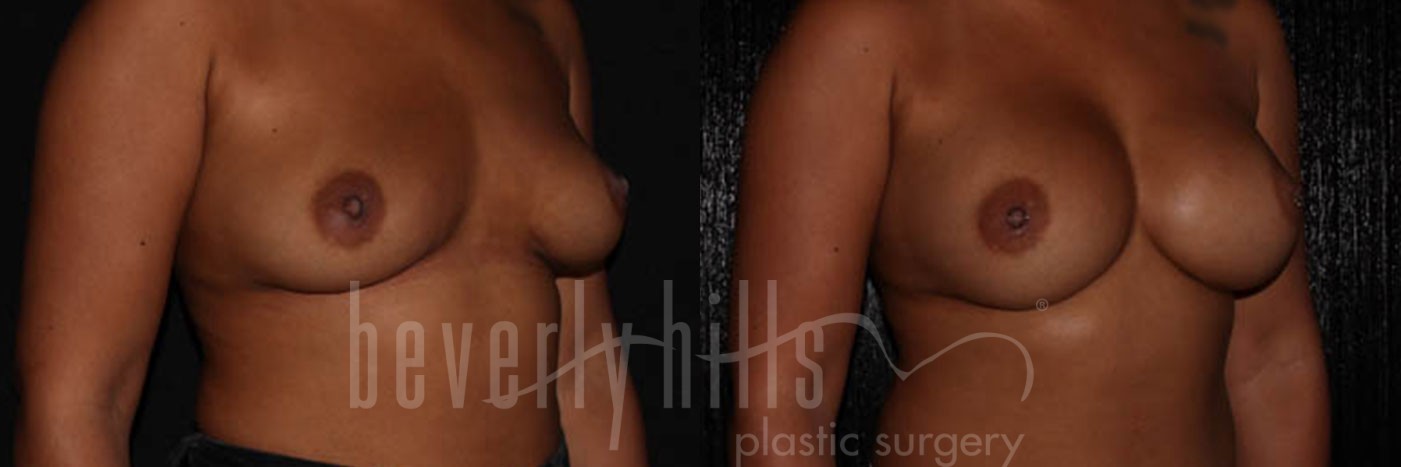 Breast Augmentation 10 Before & After