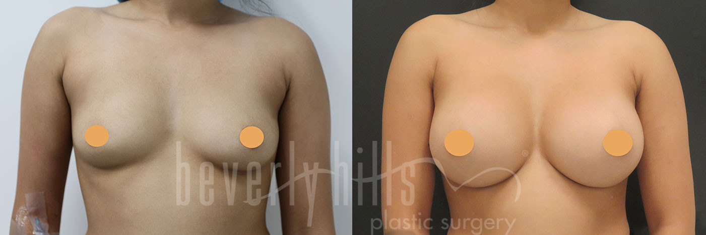 Breast Augmentation 100 Before & After
