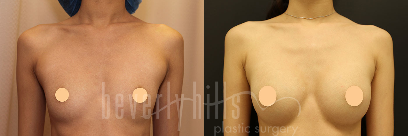 Breast Augmentation 101 Before & After