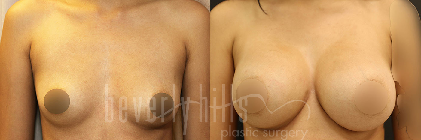 Breast Augmentation 103 Before & After