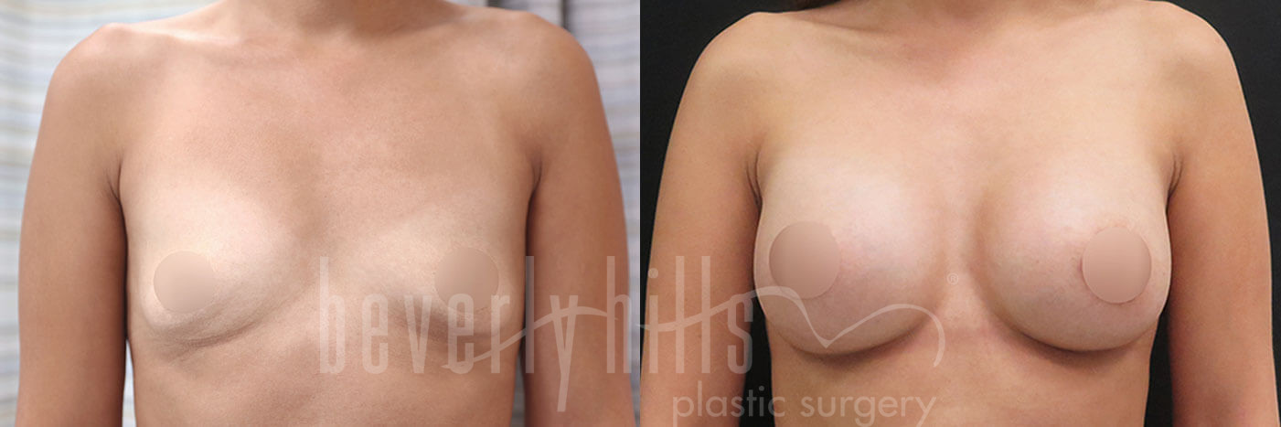 Breast Augmentation 104 Before & After