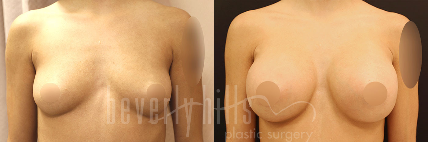 Breast Augmentation 106 Before & After