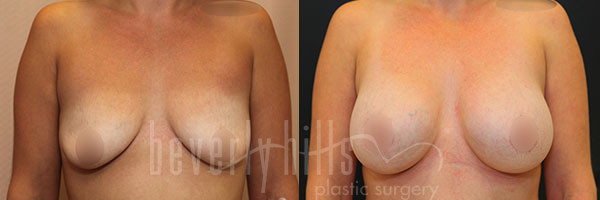 BREAST AUGMENTATION 108 Before & After