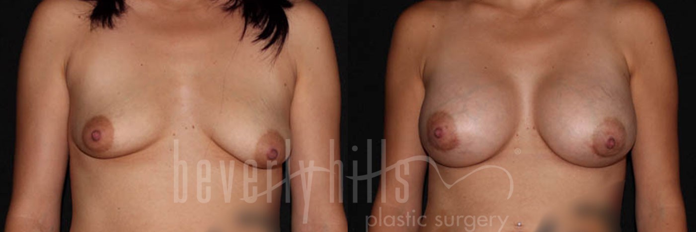 Breast Augmentation 11 Before & After