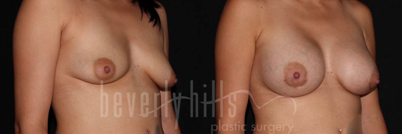 Breast Augmentation 11 Before & After