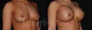 Breast Augmentation 12 Before & After - Thumbnail