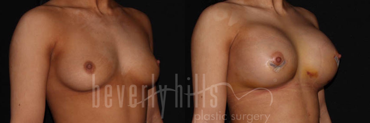 Breast Augmentation 12 Before & After