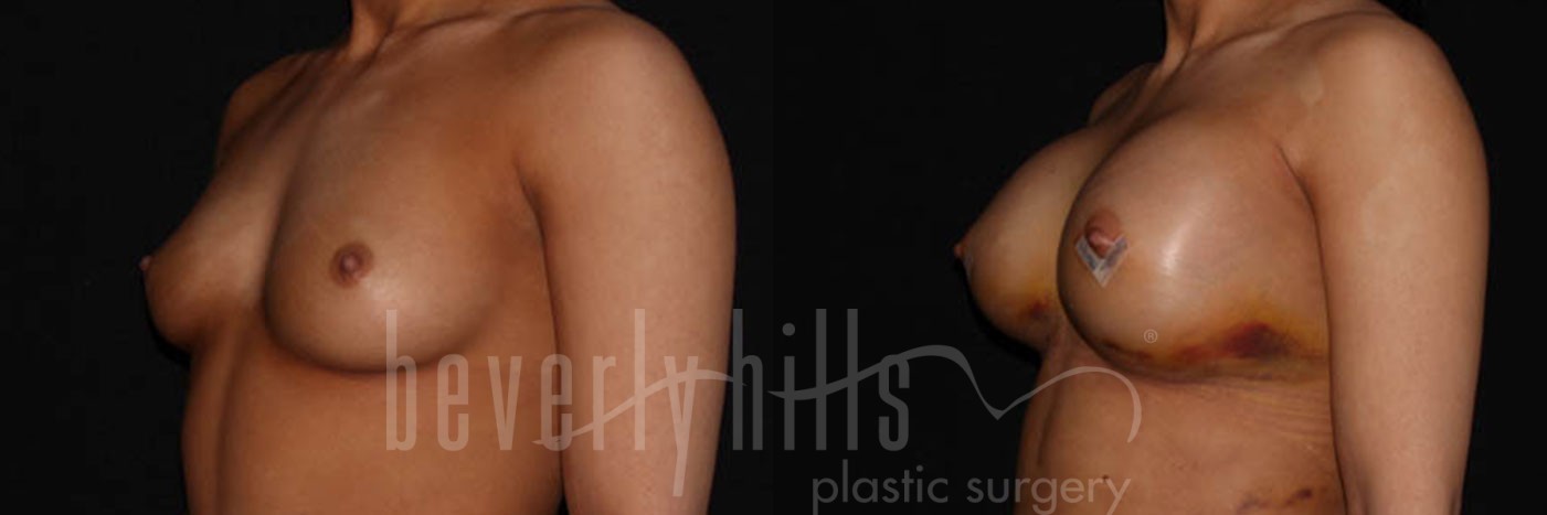 Breast Augmentation 12 Before & After