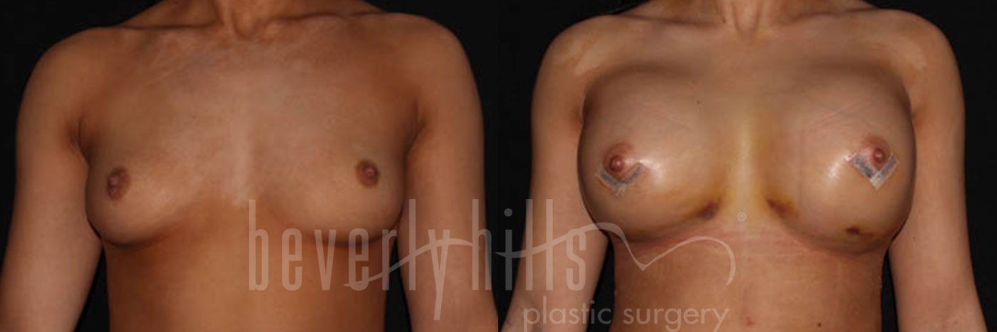 Breast Augmentation 12 Before & After