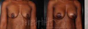 Breast Augmentation 14 Before & After - Thumbnail