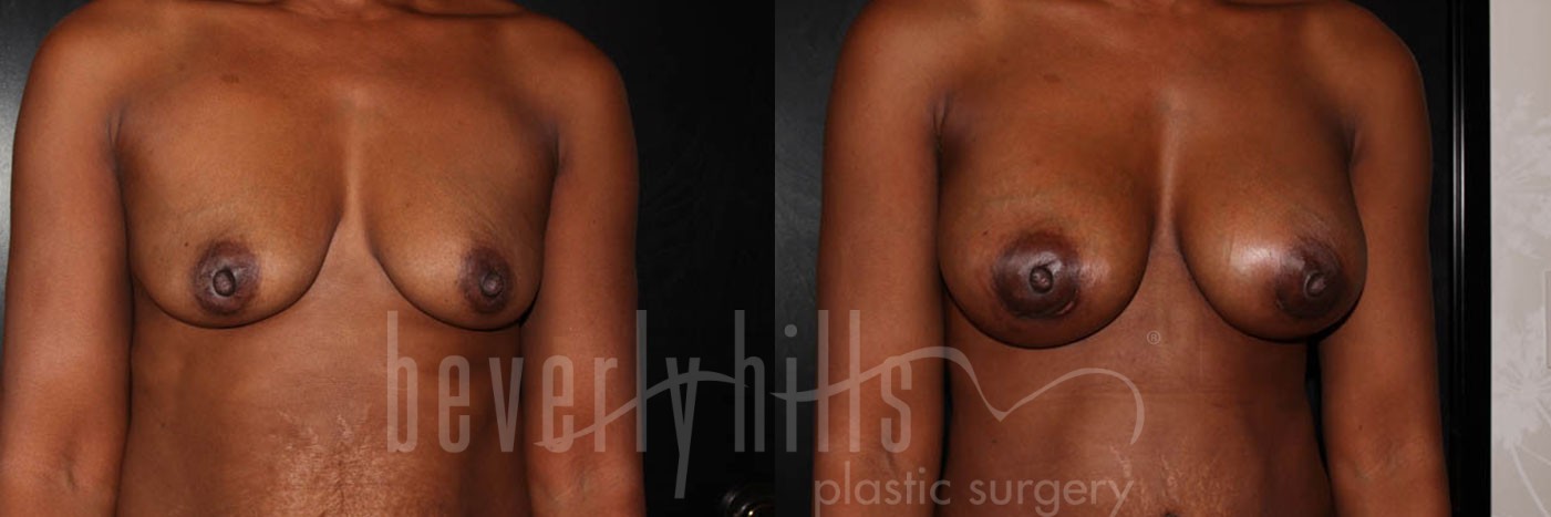 Breast Augmentation 14 Before & After