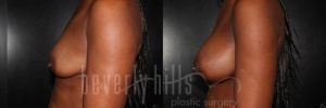 Breast Augmentation 14 Before & After - Thumbnail