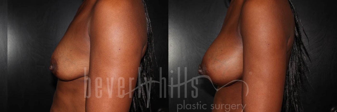 Breast Augmentation 14 Before & After