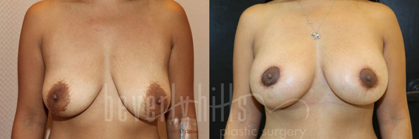 Breast Augmentation 15 Before & After