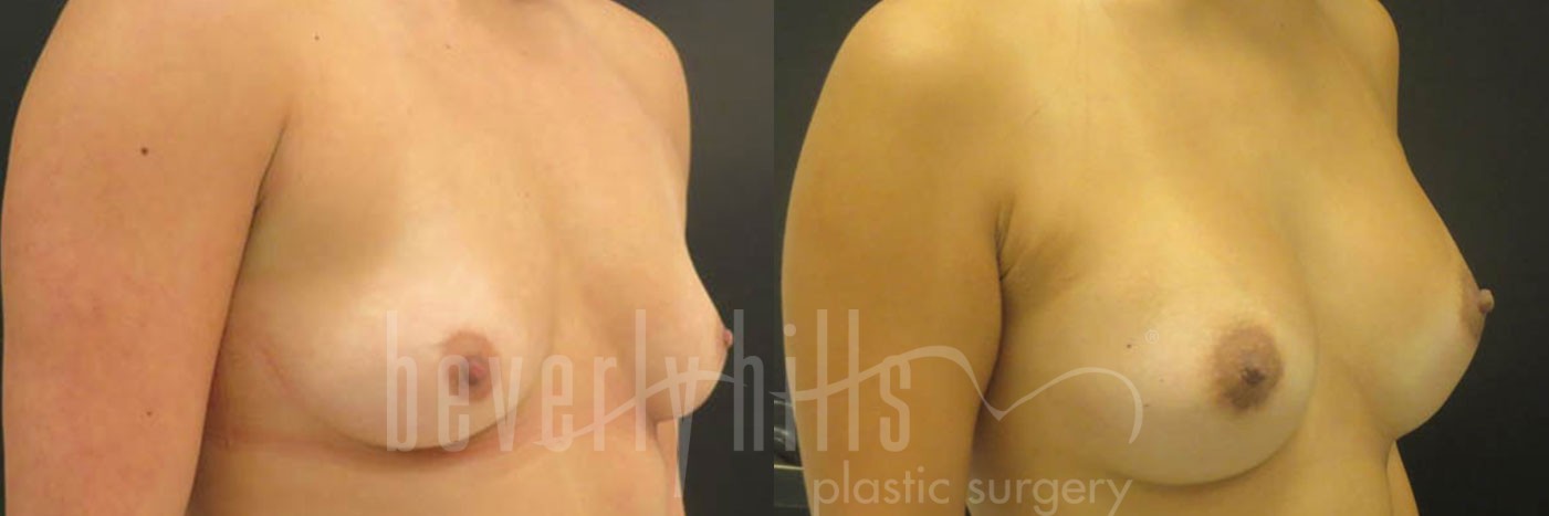 Breast Augmentation 16 Before & After