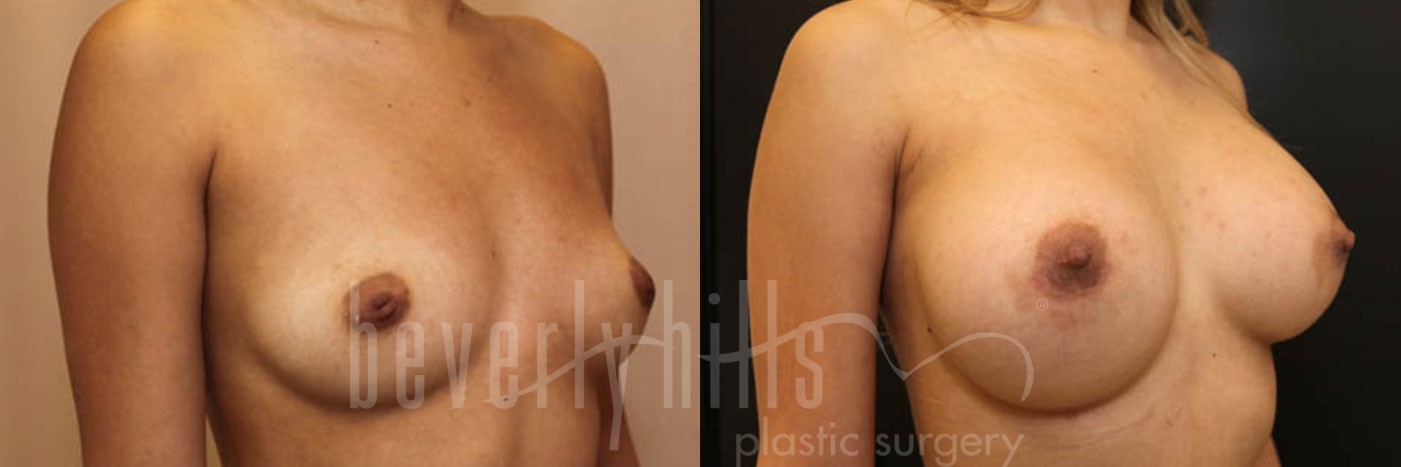 Breast Augmentation 17 Before & After