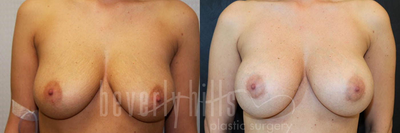 Breast Augmentation 18 Before & After